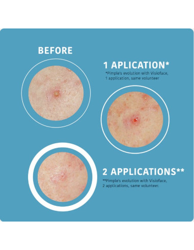 IROHA NATURE ACNE PRONE SOS...