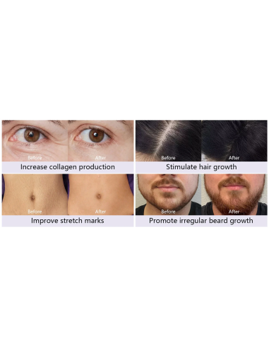 Dr. Pen Microneedling-apparat...