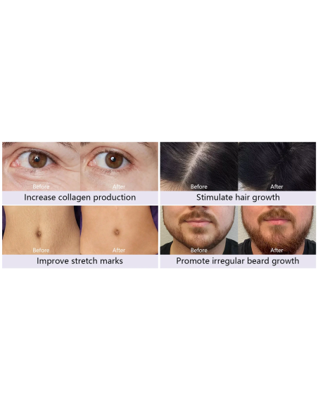 Dr. Pen Microneedling-apparat Dermapen A10, med batteri